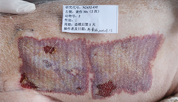 深II度烫伤模子